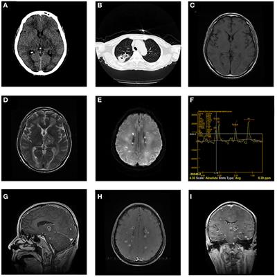 Multifocal brain abscesses caused by invasive Streptococcus intermedia: A case report